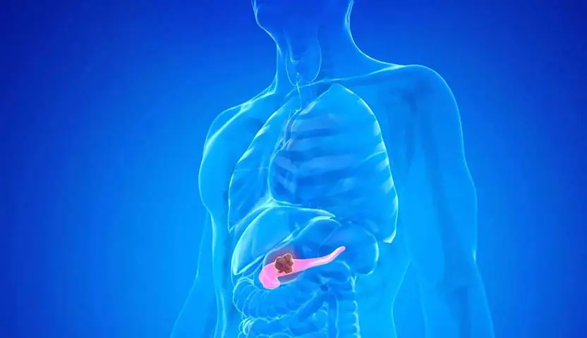كل ما تريد معرفته عن أسباب التهاب البنكرياس