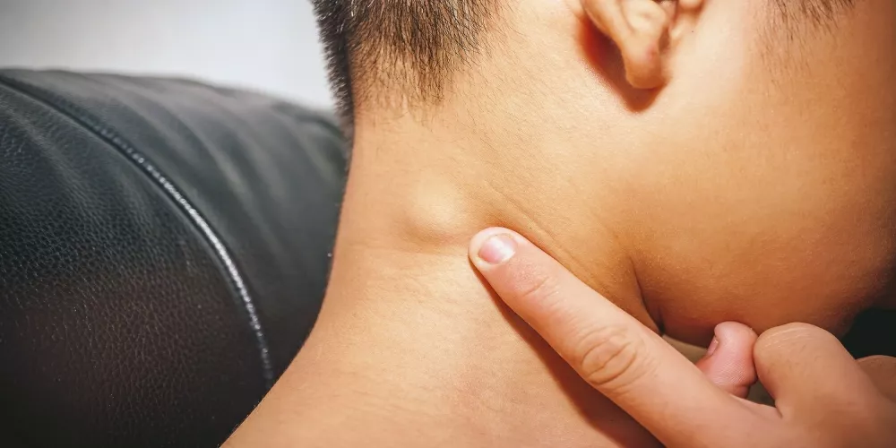 هل أي تضخم في الغدد الليمفاوية يعتبر ورم خبيث؟ الحقيقة الطبية الشاملة
