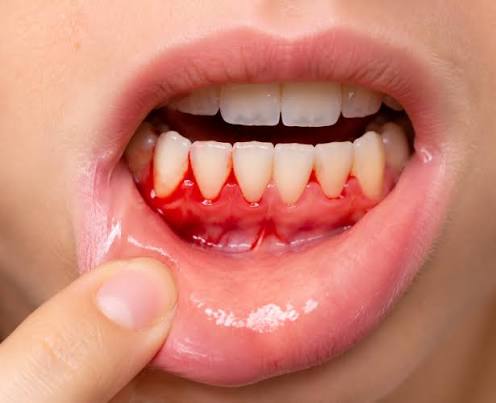 متى يكون نزيف اللثة المتكرر علامة على اضطرابات الدم؟